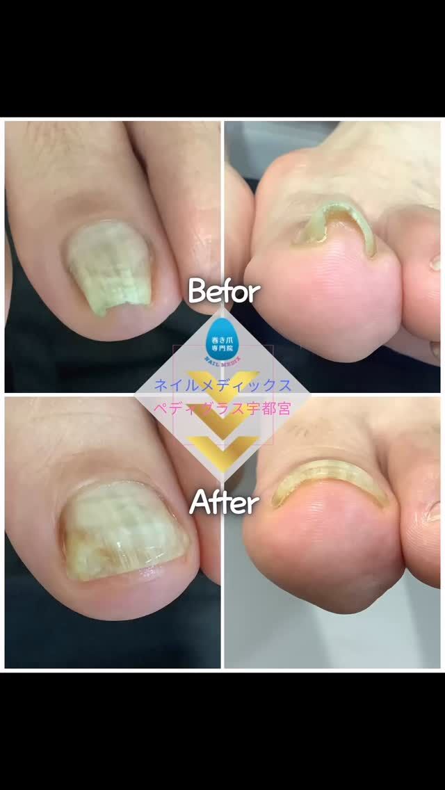 ペディグラス　巻き爪　ネイルケア 巻き爪ケア ペディグラステクノロジー