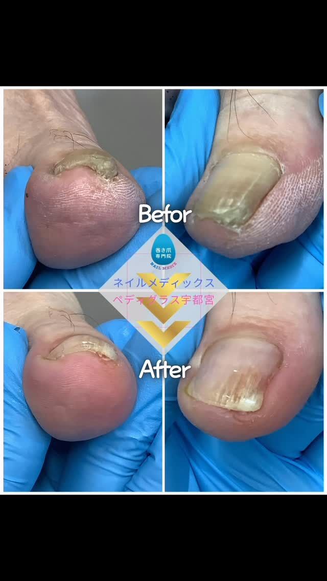 ネイルメディックス宇都宮巻き爪補正院